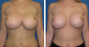 Before & After Photos